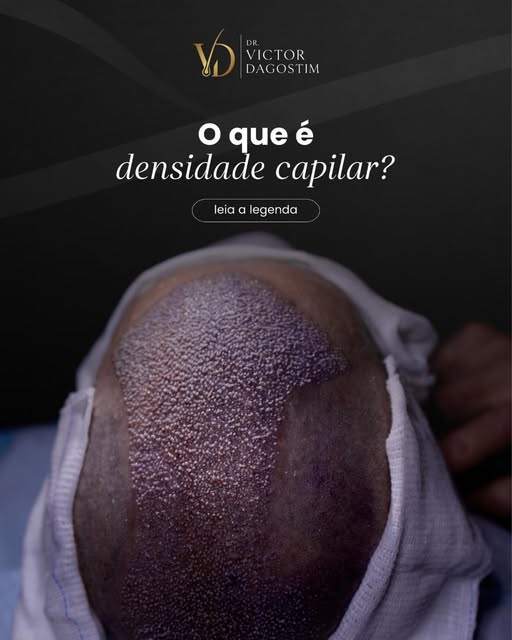 A densidade capilar nada mais é do que a quantidade de fios de cabelo (ou de unidades foliculares) p
