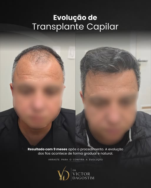 A evolução do transplante capilar acontece de forma gradual.

Neste caso, acompanhamos diferentes fa