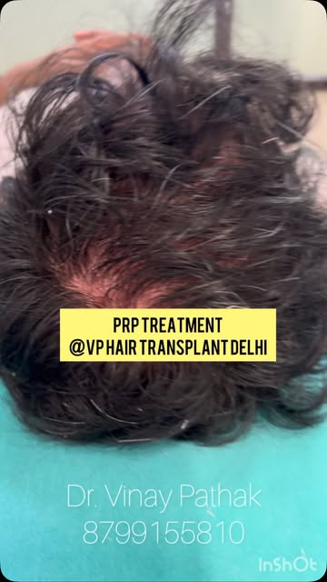 Prp Benifits #prp #hairtreatment #bald #prptreatment