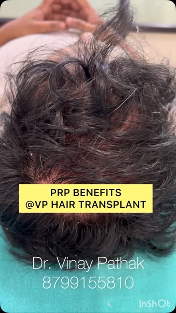 Prp benefits ##prp #bald #hairtreatment #hairtransplant