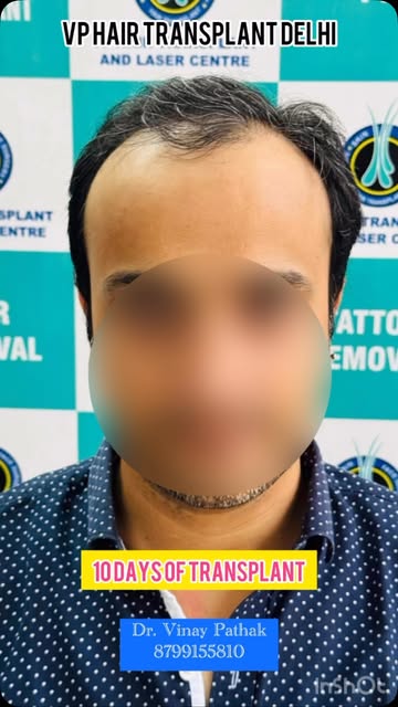 Best hair transplant centre in India #hairtransplant #haircare #baldhead