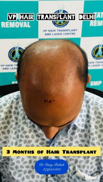 Hair transplant in India dr. Vinay Pathak #hairtreatment❤️‍🩹 #bald #balamovie #viral