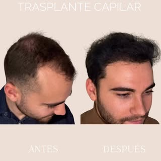 ✨Un nuevo marco, una nueva imagen, una nueva energía con trasplante capilar en clínica Inderma✨

Hoy