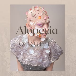 Alopecia 🧑🏻‍🦲

#alopecia #alopecianbeauty #tricologiamedica #courocabeludo #hair #cabelo #medicin