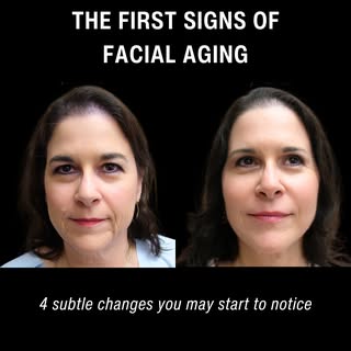 Facial aging doesn't happen all at once, it happens gradually.

The first signs often include volume