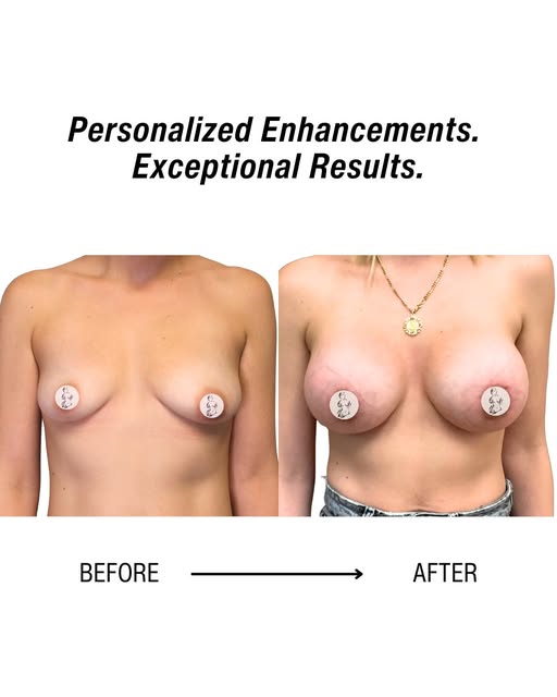 A beautiful breast augmentation is about more than adding volume, it’s about creating balance, propo