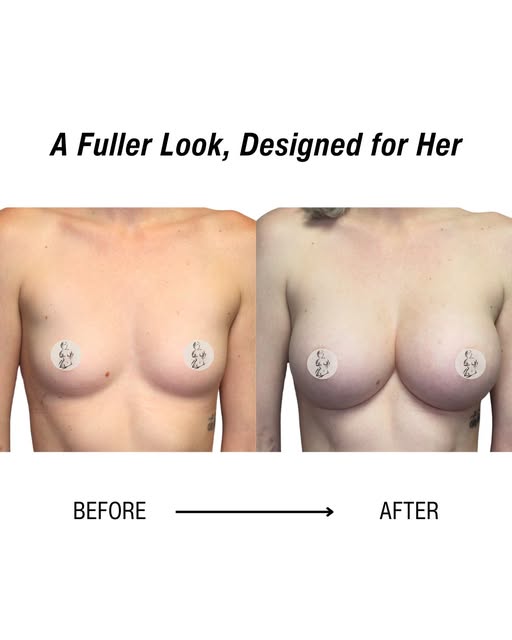 From flat to fuller. ✨

A beautiful example of how breast augmentation can transform volume, shape, 