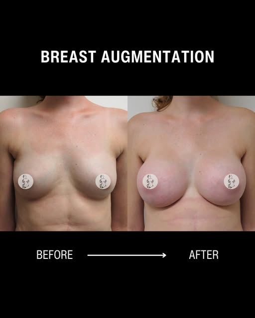 Every breast augmentation is designed with one goal in mind: creating results that feel natural, bal