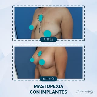 La mastopexia permite elevar el busto caído logrando mantenerlos firmes y estéticos. Esta cirugía pu
