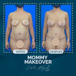 Mastopexia + abdomino + liposucción

📌El Mommy makeover es un procedimiento quirúrgico innovador qu