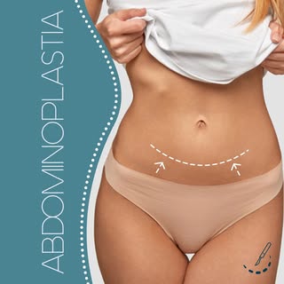 La Abdominoplastia es un procedimiento de cirugía estética en el que se corrigen los defectos del ab