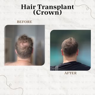 🌟 Doctor-Led Hair Transplant🌟 Crown 👑 

We take great pride in being a reputable and professional