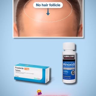 Will Finasteride or Minoxidil grow back hair?

#finasteride #minoxidil #hairtransplantuk #hair