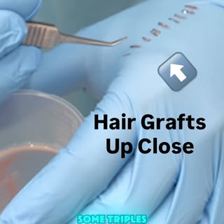 What hair grafts really look like?

#hairgraft #hair #drditta