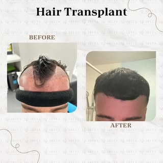 🌟 Doctor-Led Hair Transplant🌟 

We take great pride in being a reputable and professional hair tra