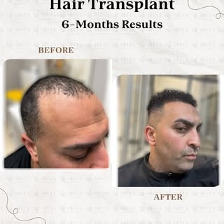 🌟 Doctor-Led Hair Transplant🌟 

We take great pride in being a reputable and professional hair tra