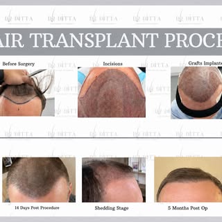 Illustration of a FUE hair transplant procedure performed on this patient. The image shows the diffe