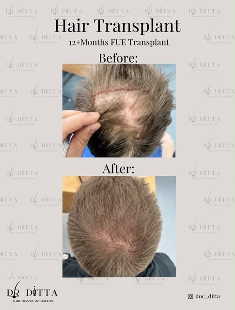 FUE Hair Transplant to the Anterior Crown / Crown region. The natural direction of growth had been f