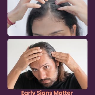 Hairline Peeche Ja Rahi Hai? Don’t Ignore The Early Signs! 🚨

Hairline recession is not always just