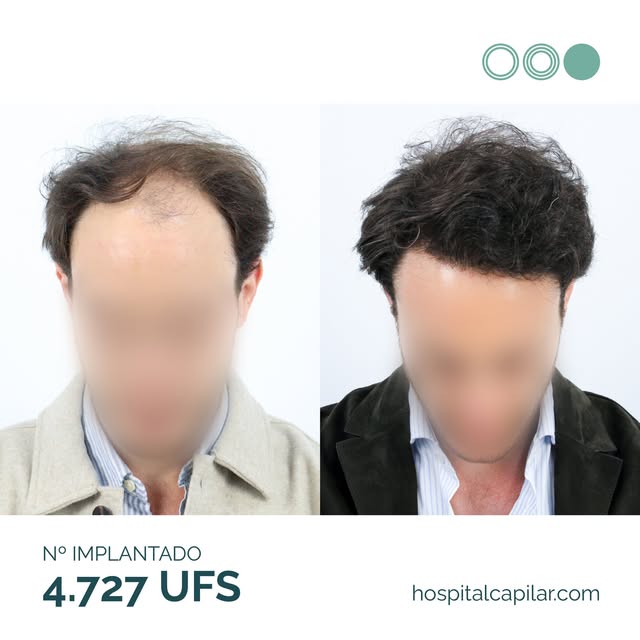 Un año del injerto capilar 🔝

Nuestro paciente llegó a Hospital Capilar con una alopecia avanzada A