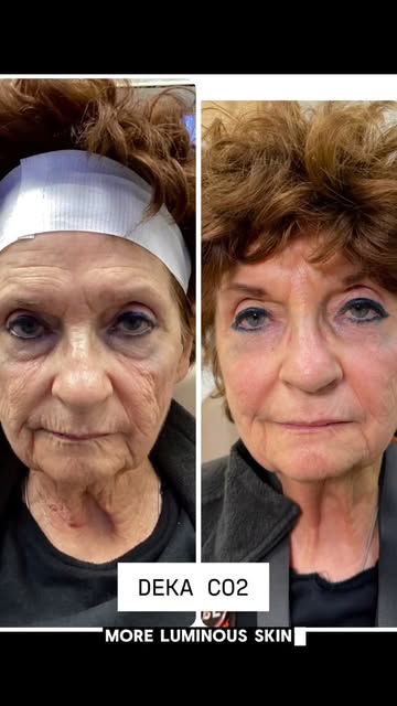 The power of DEKA CO2 is real!!!! 
Crepey skin, fine lines, and loss of firmness? This is where Deca