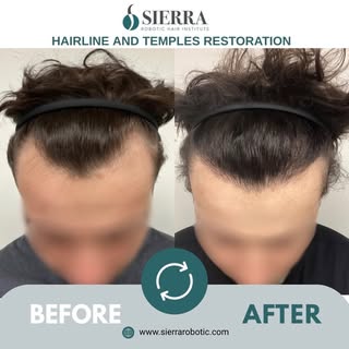 Sometimes the most impactful transformations are the most subtle..✅

This patient underwent a 1,300-