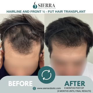 This patient underwent a 2000 graft hair transplant to restore the hairline and front one-third of t