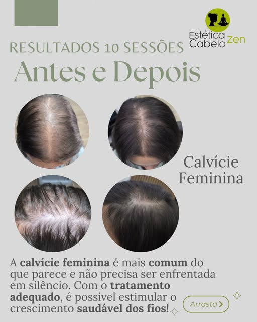 Tratamento para calvície feminina, resultados que devolvem muito mais que cabelo devovem autoestima 