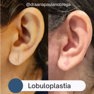 ✨ Lobuloplastia: pequenos detalhes que fazem grande diferença ✨

Rasgaduras, flacidez ou alargamento