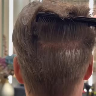 O transplante capilar No Shave tem despertado grande interesse entre pacientes que desejam realizar 