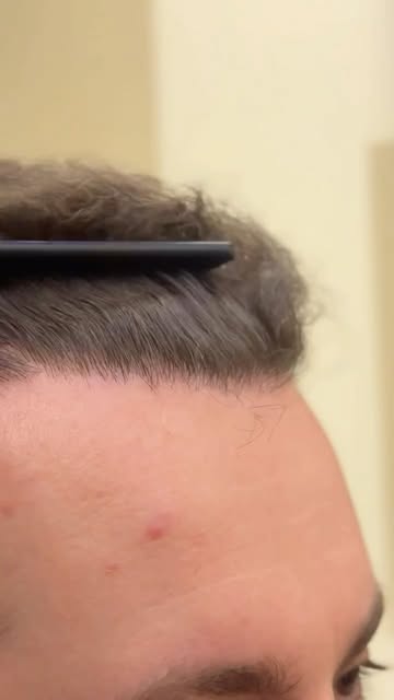 Cada paciente é único, e o tratamento da queda de cabelo também deve ser.

Na consulta, avaliamos in