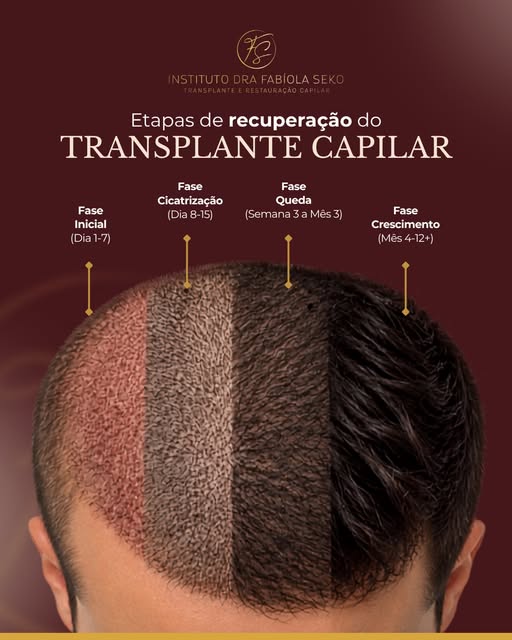 O transplante capilar é um processo que continua após o procedimento. 

Nas primeiras semanas, ocorr
