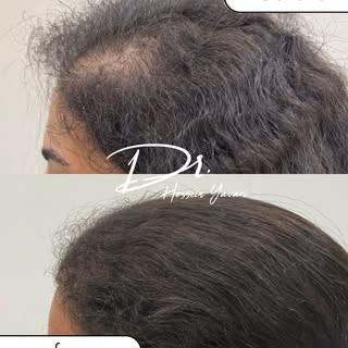 Young girl hair transplant results?
Natural hair, natural beauty, permanent confidence. 

The goal w
