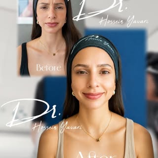 Top three considerations while doing Botox:
1. Right doctor 
2. Right long lasting product 
3. Natur