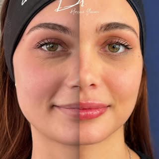 Can You Spot the Filler??
Because great lip filler shouldn’t announce itself!
It should make people 