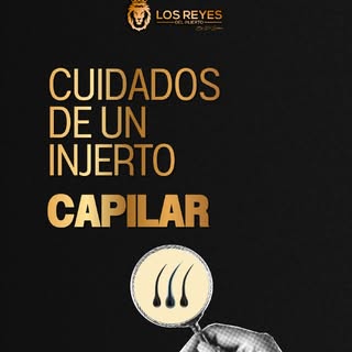¿Ya te realizaste un injerto capilar? Los cuidados posteriores son clave para acompañar una buena re