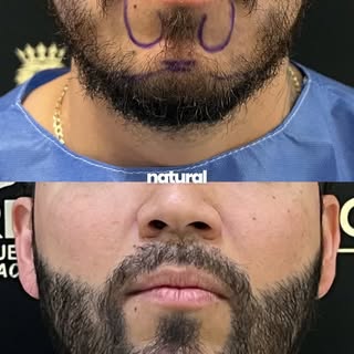 Antes de diseñar tu barba, hay que conocerla 🧔🏻‍♂️🔍

En un injerto de barba no se trata solo de p