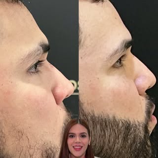 Si buscas más densidad, definición o una forma que favorezca tus facciones, un injerto de barba pued