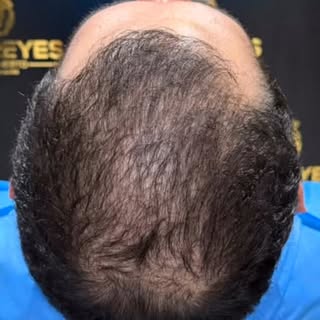 La clave de un injerto exitoso: un tratamiento previo completo. 💡🧔‍♂️

Fortalecemos el cabello exi