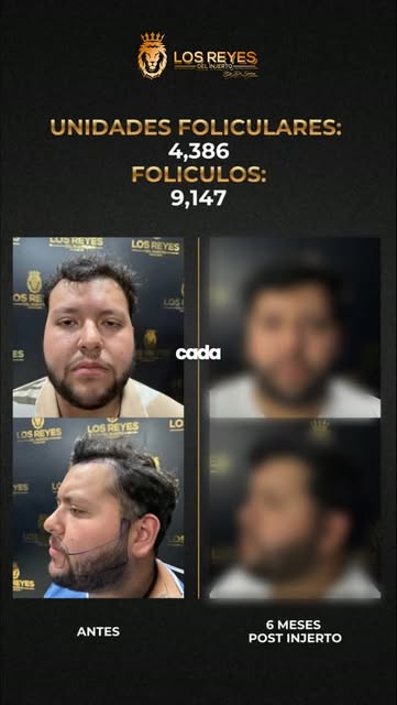 Este resultado a 6 meses es parte de un proceso diseñado específicamente para nuestro paciente ⭐

Lí