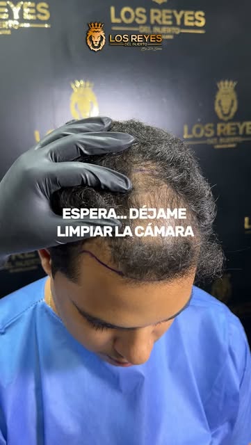 Después de un injerto, hasta la cámara parece otra 🫨

Si ya estás pensando en dejar de esconder tus