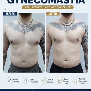 ✨ 6 MONTHS POST GYNECOMASTIA SURGERY RESULTS ✨

Confidence restored. Chest redefined. 💪🔥

✅ Things
