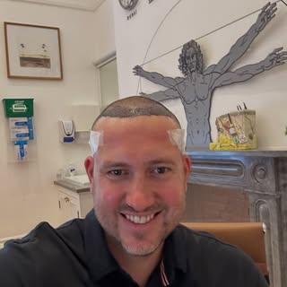 #hairtransplant #hairloss #hair #trichology