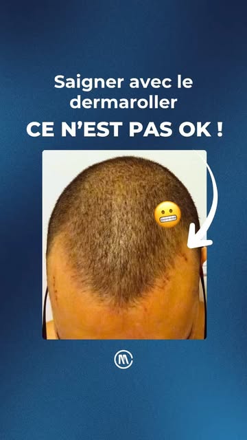 NON ⚠️ Saigner avec le dermaroller n’est pas normal ! 🙅‍♂️
#dermaroller #pertecheveux
