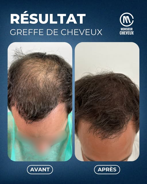 🎯 Objectif : À 39 ans, notre client souhaitait améliorer la densité au niveau du vertex pour retrou