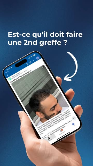 Est-ce qu’il peut faire une seconde greffe de cheveux ? 🤔 #greffecheveux #analysegreffe