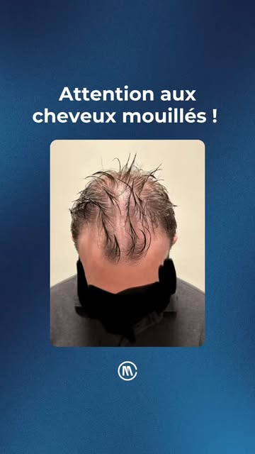 Est-ce que cette personne peut envisager une greffe de cheveux ? #greffecheveux
