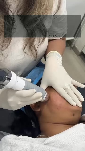 Acne is gone… and left scars behind as memory 👀

Those dents and uneven texture aren’t just sitting