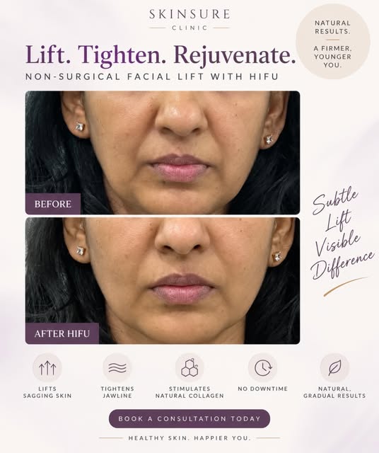 A little lift can make a big difference. ✨

This HIFU before & after shows what I love about collage