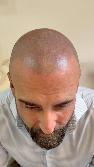 Puedes seguir pensándolo.
O puedes descubrirlo.

Micropigmentación capilar efecto rapado.
Un resulta